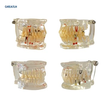 Dental Oral Care Dente Dentes Modelo Dentário Ortodôntico Modelo para a Comunicação do Paciente Dentista Estudo do Modelo
